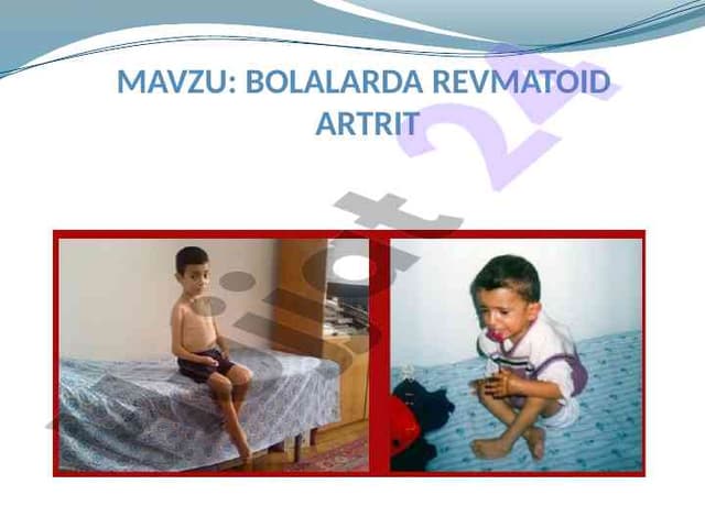 Romatoid Artritning Bolalarda